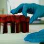 Routine blood test may suggest future dementia risk