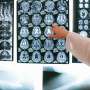 Cancer markers in spinal fluid may reveal tumors mistaken for autoimmune encephalitis