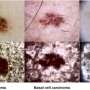 AI tool designed and integrated into hospital workflows to classify skin lesions