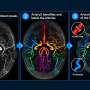 MRI analysis tool reveals brain artery differences missed by older software