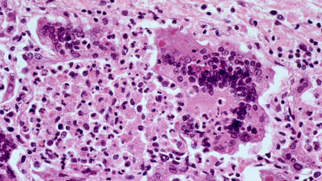 One of the most contagious diseases on the planet is having its worst U.S. outbreak since 1991