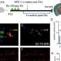 Experimental gene therapy shows promise against hydrocephalus
