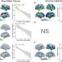 Blood marker may flag Alzheimer's-related changes in Down syndrome decades before symptoms appear