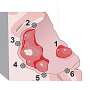 New AI tool can predict where glioblastoma is most likely to return after initial surgery