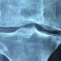 Q&A: How FDA decision is speeding development of new osteoporosis drugs
