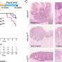 Tumor suppressor gene mutations trigger immune activation in early oral cancer