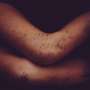 Wiskott-Aldrich syndrome: Long-term results of gene therapy developed