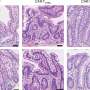 Why some patients may develop severe intestinal inflammation after CAR-T therapy