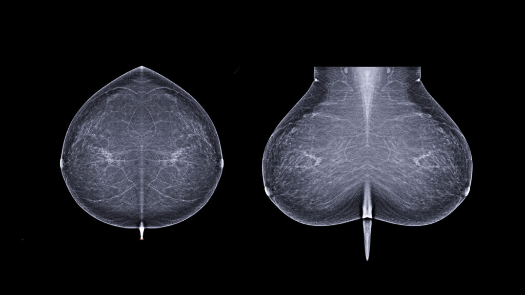 STAT+: Why this startup is taking its AI to predict breast cancer risk directly to patients