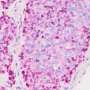 Key driver of aggressive prostate cancer identified, suggesting new way to reverse drug resistance