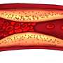 Engineered 'triple-threat' immune cells could fight plaque buildup that causes heart attacks and strokes