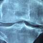Can we take the STING out of bone loss? Pathway presents potential treatment target for skeletal aging
