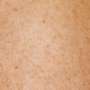 Autonomous AI could create capacity for thousands more dermatology appointments, real-world study finds