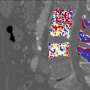AI software could detect osteoporosis in existing CT scans before bones break
