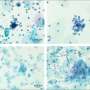 Simple test could take the pain out of uterine cancer check
