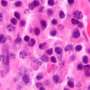 Ultra-low-dose radiation therapy relieves bone pain from multiple myeloma