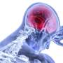 Graphene sensors reveal brain tissue at risk during stroke