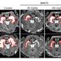New class of KRAS inhibitors shows promise in shrinking NF1 nerve tumors