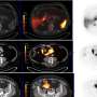 Case report highlights multidisciplinary approach to recurrent prostate cancer