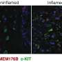 'Invisible' inflammation in rare bowel disease may explain heightened colon cancer risk