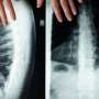 Lower spinal bone density may flag people at risk for cognitive decline