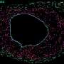 Lab-grown blood vessels reveal roles of different cells in rapid-aging disease