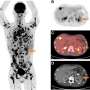Proven radiotracer highly effective in detecting rare, aggressive kidney cancer