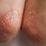Mortality, comorbidity risk increased with generalized pustular psoriasis