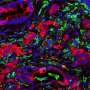 Cancer-promoting protein also helps engineered immune cells fight tumors in lab tests