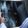 Does a bone tumor always mean cancer?