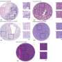 A new AI tool distinguishes Ewing sarcoma from similar tumors