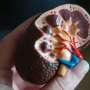 Kidney-sparing embolization reduces patients' risk of acute injury and death compared to surgery