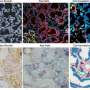 Kidney biopsy maps reveal immune clusters that may keep inflammation going
