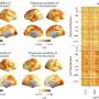 Same depression diagnosis, opposite brain patterns: Five profiles emerge