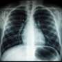 The pope has a lung nodule. What does this mean? And what's the risk of cancer?