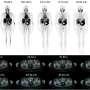 PSMA PET/CT-targeted biopsy improves detection of clinically significant prostate cancer
