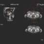 PET scans reveal alpha cancer therapy isotope with new algorithm in first human test