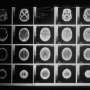 New brain tumor test could transform diagnosis and treatment