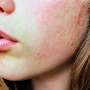 Active acupressure offers clinical benefits for rosacea