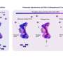 Inhaled drug shows promise for rare lung disease combination