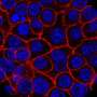 Continuously evolving cells help pancreatic cancer evade treatment and spread