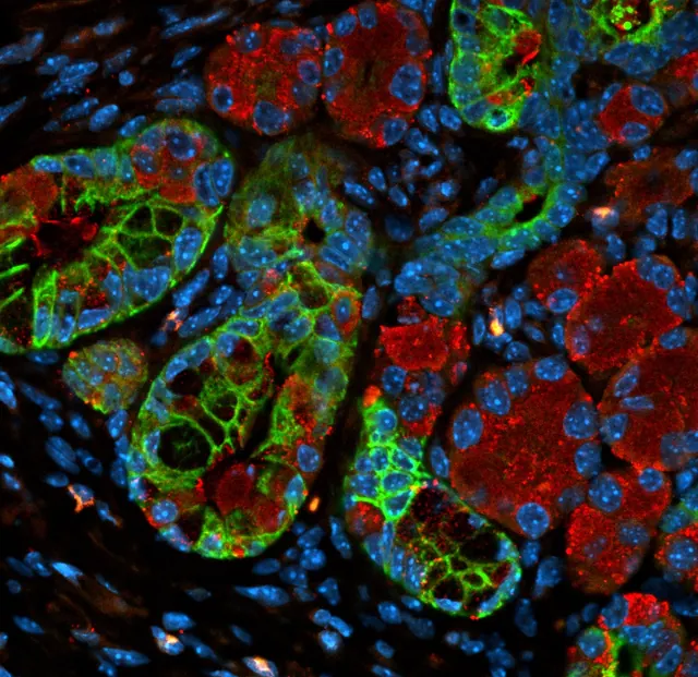 STAT+: Verastem’s KRAS inhibitor shows promise in pancreatic cancer