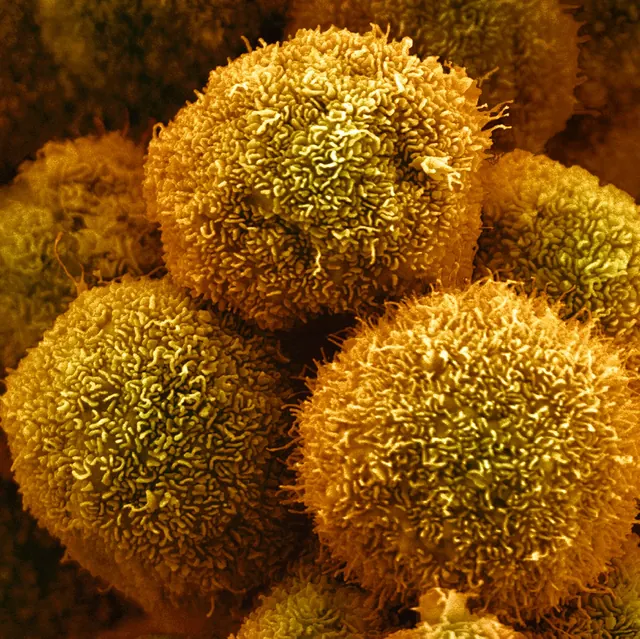 New Drug Approved by F.D.A. for Pancreatic Cancer Could Be First of Many