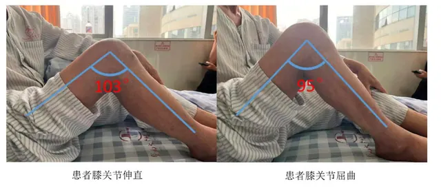 摔伤拍片未见骨折，膝关节近乎“锁死”！暨大附一院分期手术助其重获行走能力