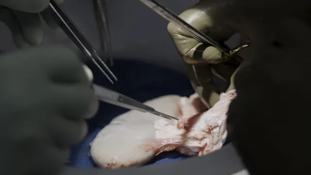 STAT+: Recipients of gene-edited pig kidneys successfully receive human organs