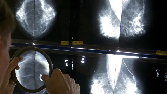 STAT+: AI for breast cancer risk prediction goes DTC, regulatory cloud over Utah sandbox, and AI psychosis