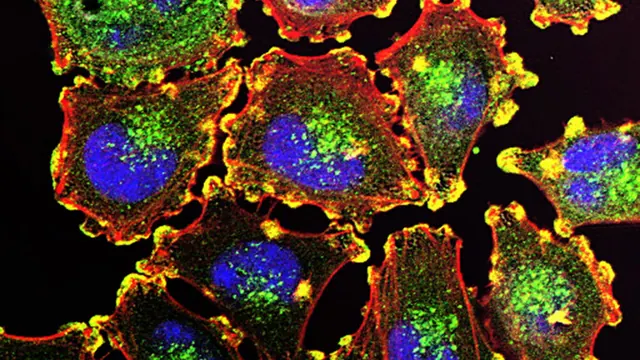 After a melanoma diagnosis, mRNA cancer vaccine delivered a patient hope — and a path forward