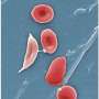 Sickle cell pain may involve previously unrecognized biological pathways