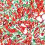 Powerful new tool reveals potential 'goldmine' of cancer targets hidden in 'junk DNA'