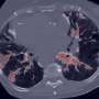 AI model uses routine imaging to identify patients at risk for serious treatment-induced lung inflammation